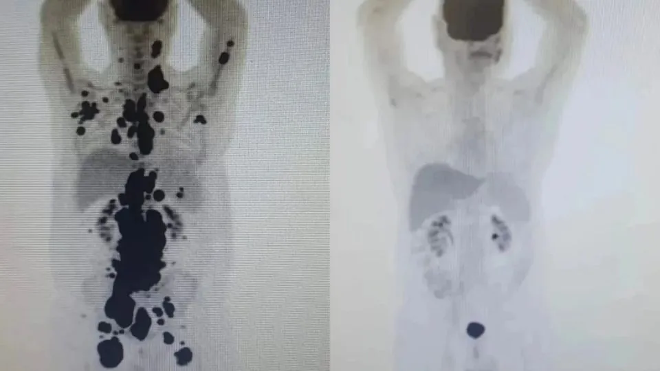 Imagem ilustrativa da imagem Tratamento de câncer: Anvisa autoriza pesquisa clínica com células CAR-T no Brasil