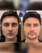 Imagem ilustrativa da imagem Harmonização Facial Masculina: Dicas e Cuidados Essenciais para Realçar sua Beleza