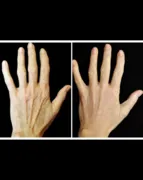Imagem ilustrativa da imagem Radiesse para as Mãos: O Toque de Juventude que Suas Mãos Merecem
