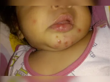Imagem ilustrativa da imagem Laudo indica infecção generalizada em bebê que morreu após tomar injeção com dipirona