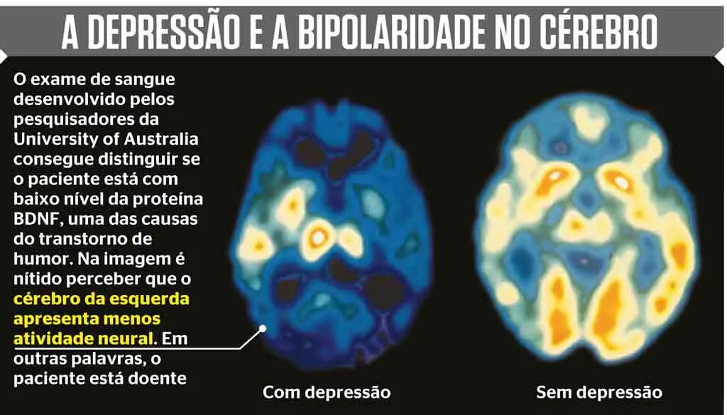 Imagem ilustrativa da imagem Transtorno afetivo bipolar: o que é, sintomas e tratamento