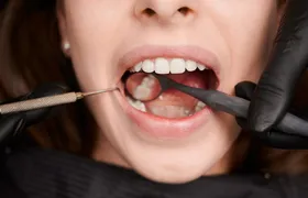 Imagem ilustrativa da imagem Dentes do Siso: Mitos, verdades e importância