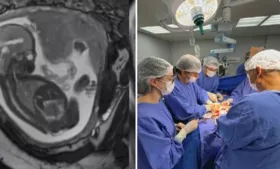Imagem ilustrativa da imagem Bebê passa por cirurgia dentro da barriga da mãe