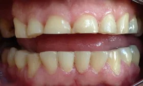 Imagem ilustrativa da imagem Bruxismo: o ranger de dentes que cresce e pode custar caro a sua saúde