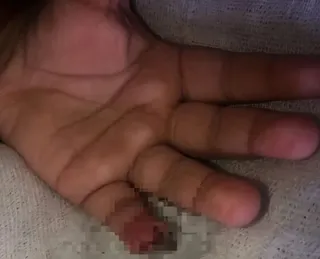 Bebê de um ano e quatro meses tem parte do dedo cortado em CMEI