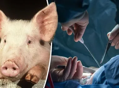 Imagem ilustrativa da imagem Paciente recebe coração artificil e rim de porco para viver