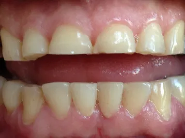 Imagem ilustrativa da imagem Bruxismo: o ranger de dentes que cresce e pode custar caro a sua saúde