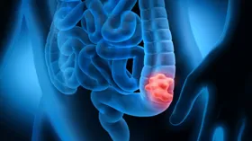 Imagem ilustrativa da imagem Internação por câncer de intestino cresce 64% em uma década