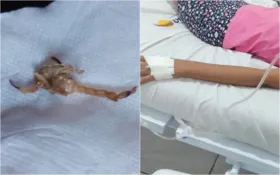 Imagem ilustrativa da imagem Criança é atacada por escorpião ao calçar bota em Catalão