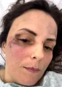 Imagem ilustrativa da imagem Mulher agredida e baleada por PM aposentado passará por cirurgia