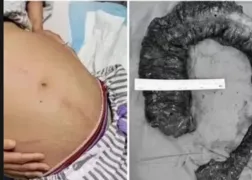 Imagem ilustrativa da imagem Constipação severa: médicos retiram cocô de 1 metro e 20 kg de mulher