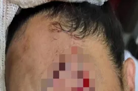 Imagem ilustrativa da imagem Babá tem rosto rasgado após ser atacada por pit-bull