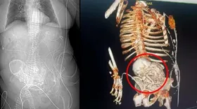 Imagem ilustrativa da imagem Idosa carrega feto calcificado por mais de 50 anos e morre durante cirurgia