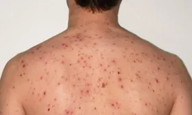 Imagem ilustrativa da imagem Ministério da Saúde declara surto de sarampo em Goiânia