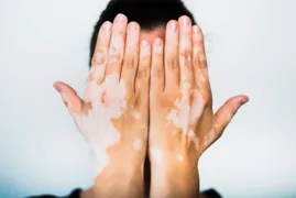 Imagem ilustrativa da imagem Vitiligo - o estigma social por trás das manchas