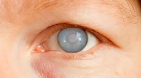 Imagem ilustrativa da imagem Glaucoma: diagnóstico precoce e tratamento evitam perda da visão