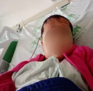 Imagem ilustrativa da imagem Após progressiva capilar, garota de 9 anos é internada e passa por cirurgia