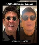 Imagem ilustrativa da imagem Sergio Mallandro passa por harmonização facial e internautas fazem comparações