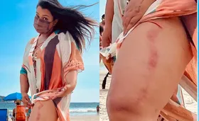 Imagem ilustrativa da imagem Preta Gil é 'atropelada' por barraca de praia: "Toda roxa e ardendo"