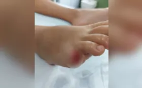 Imagem ilustrativa da imagem Criança de 10 anos perde dedo do pé após ser atacada por piranha no Lago das Brisas