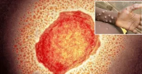 Imagem ilustrativa da imagem Caso de varíola identificado em Massachusetts aumenta alerta sobre eventual surto