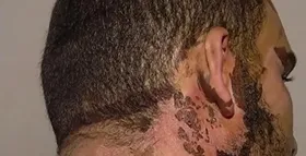 Imagem ilustrativa da imagem Paciente deverá ser indenizado após ter queimaduras ao ser tratado com produto veterinário para tirar larvas no ouvido